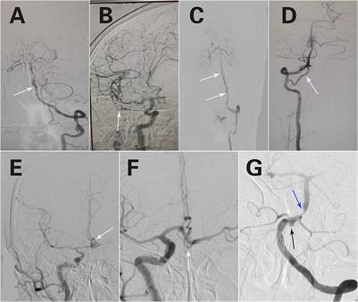 Retrospective analysis of image characteristics of 76 cases of cerebral vascular fenestrations